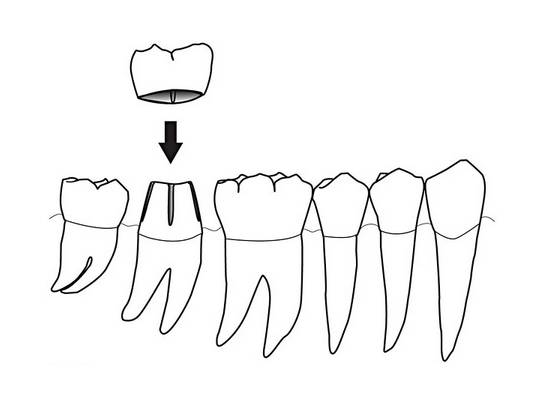 牙冠修复是什么?